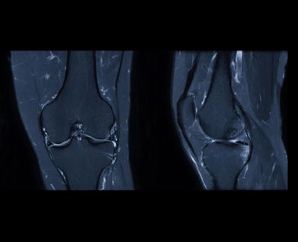 Compare of MRI knee or Magnetic resonance imaging of knee joint stir technique of coronal and sagittal view for fat suppression.