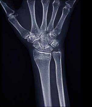 X-ray image of Right wrist joint Ap view for diagnosis rheumatoid arthritis .