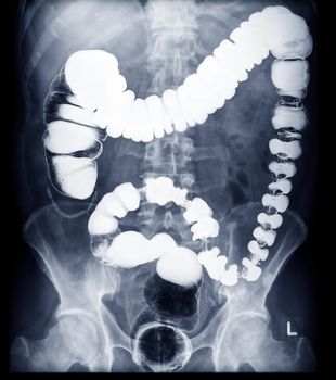 BE or barium enema image or x-ray image of colon prone view showing anatomical of colon for detect Colon cancer .