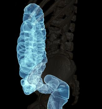 CT colonography or CT Scan of Colon 3D Rendering image lateral view showing colon for screening colorectal cancer. Check up Screening Colon Cancer.