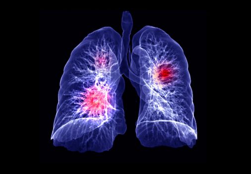 CT Chest or Lung 3D rendering image showing lesion ( Red ) for diagnosis TB,tuberculosis and covid-19 .