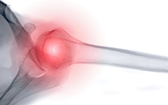 X-ray Shoulder joint shoulder transaxillary view for diagnosis fracture of shoulder joint.