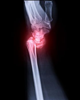 X-ray image of Left wrist joint Lateral view for showing fracture of radius bone.