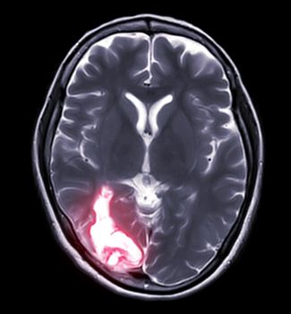 MRI brain Axial T2W view showing enchepalomalacia disease.