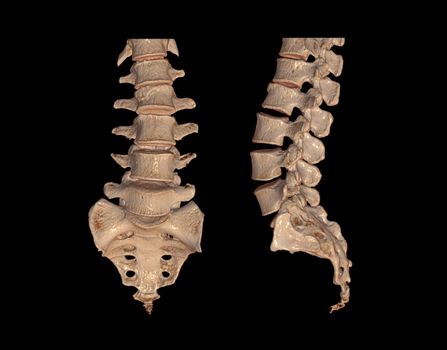 Collection of CT Lumbar or L-S spine 3D rendering image AP and Lateral view showing Compression fractures at L2. 3D illustration.