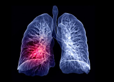 Selective focus of CT Chest or Lung 3D rendering image turn around on the screen for diagnosis TB,tuberculosis and covid-19 .