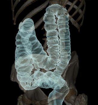 CT colonography 3D Rendering image showing colon for screening colorectal cancer. Check up Screening Colon Cancer.