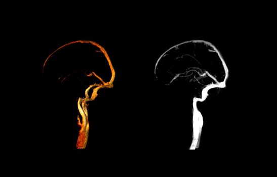 CTV BRAIN Lateral view compare 3D and MIP image.