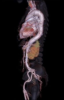 CTA abdominal aorta 3D rendering image on transparent skeletal .
