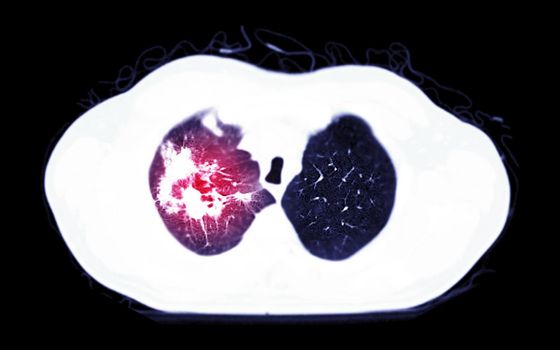 Selective Focus of CT Chest AXIAL MIP view for diagnostic Pulmonary embolism (PE) , lung cancer and covid-19.