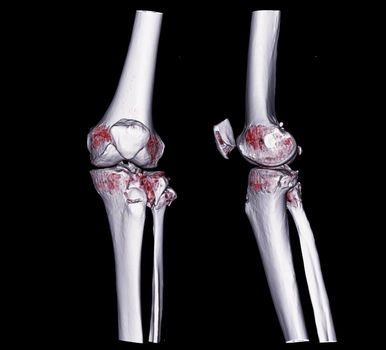 CT knee 3D rendering image AP and Lateral view isolated on black background showing fracture tibia.