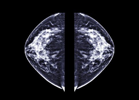 X-ray Digital Mammogram or mammography both side of the breast CC view for finding Breast cancer in women .