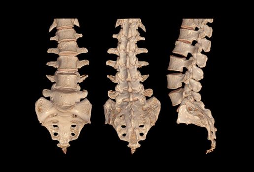 Collection of CT Lumbar or L-S spine 3D rendering image Front , back and Lateral view showing Compression fractures at L2. 3D illustration.