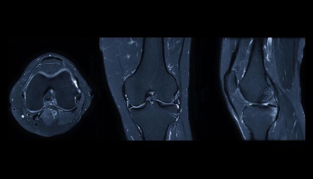 Compare of MRI knee or Magnetic resonance imaging of knee joint stir technique of axial, sagittal and coronal view for fat suppression.