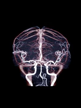 Fusion image og MRA and MRV brainshowign circulation blood flow if the brain.