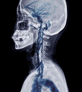 X-ray C-spine or x-ray image of Cervical spine AP view with cta carotid artery for diagnostic intervertebral disc herniation.