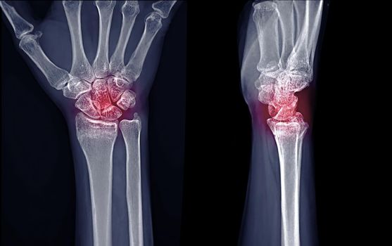 X-ray image of Right wrist joint Ap and Lateral view for diagnosis rheumatoid arthritis .