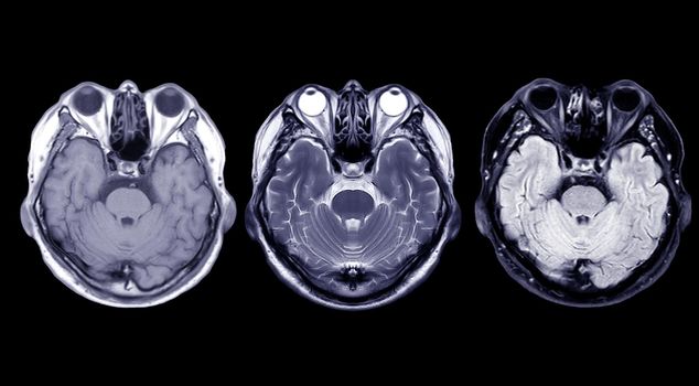 Compare MRI of the brain Axial T1, T2 and T2 Flair view for detect a variety of conditions of the brain such as cysts, tumors, bleeding isolated on black backgroud , bleeding .