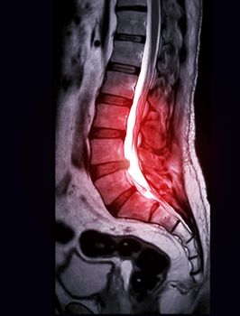 Selective focus of MRI L-S spine or lambar spine sagittal T2 technique for diagnosis spinal cord compression.