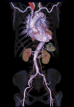 CTA abdominal aorta 3D rendering image on transparent skeletal .