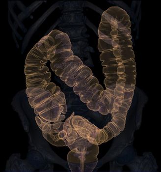 CT colonography 3D Rendering image showing colon for screening colorectal cancer. Check up Screening Colon Cancer.