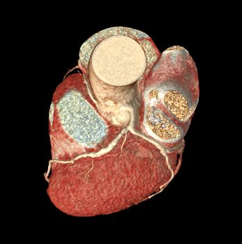 Top view of CTA Coronary artery 3D rendering image isolated o black backgroud for finding coronary artery disease.Clipping path.