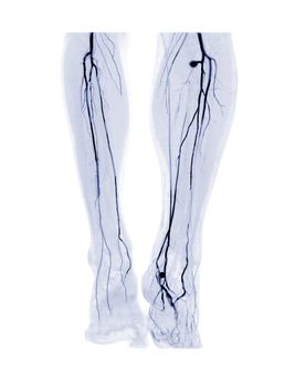 CTA femoral artery run off 3D MIP image or CTA leg for diagnosis Acute or Chronic Peripheral Arterial Disease in Diabetic patient.