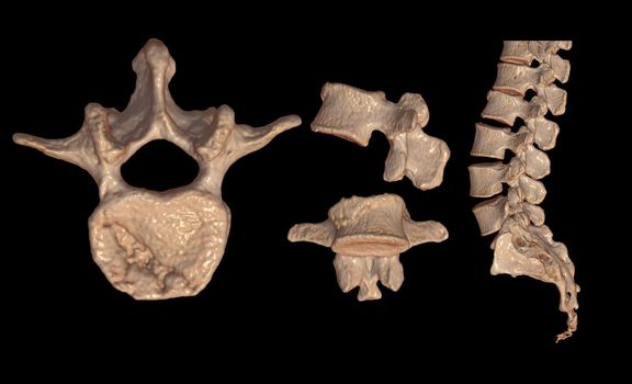 Collection of CT Lumbar or L-S spine 3D rendering image showing Compression fractures at L2. 3D illustration.