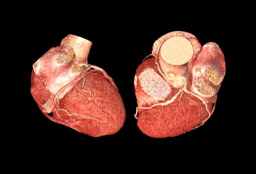 Lateral ad Top view of CTA Coronary artery 3D rendering image isolated o black backgroud for finding coronary artery disease.