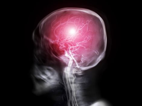 selective focus of Skull x-ray image of Human skull lateral view fusion with MRA Brain image .