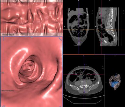 CT colonography or CT Scan of Colon axial view vs Coronal view and 3D rendering image on the screen for diagnosis large bowel cancer.