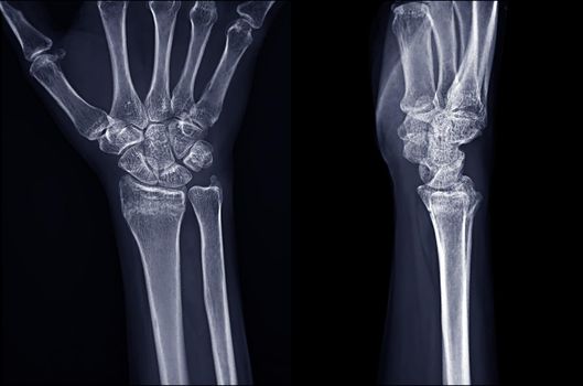 X-ray image of Right wrist joint Ap and Lateral view for diagnosis rheumatoid arthritis .