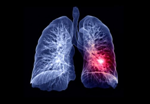 Selective Focus of CT Chest or Lung 3D rendering image showing lesion left area for diagnosis TB,tuberculosis and covid-19 .