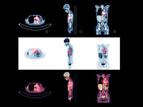 PET Scan image of whole body Comparison Axial , Coronal and Sagittal plane for detect cancer recurrence after surgery. medical technology concept.