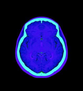 colorful of CT angiography of the brain or CTA brain Axial , Coronal and Sagittal view . Clipping path.