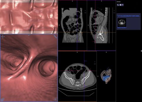 CT colonography or CT Scan of Colon axial view vs Coronal view and 3D rendering image on the screen for diagnosis large bowel cancer.