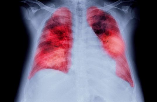 Chest X-ray or X-Ray Image Of Human Chest or Lung ( red zone ) showing tuberculosis
Tuberculosis (TB) and corona virus 2019.