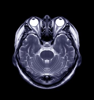 MRI of the brain Axial T2 view for detect a variety of conditions of the brain such as cysts, tumors, bleeding isolated on black backgroud , bleeding . Clipping path.