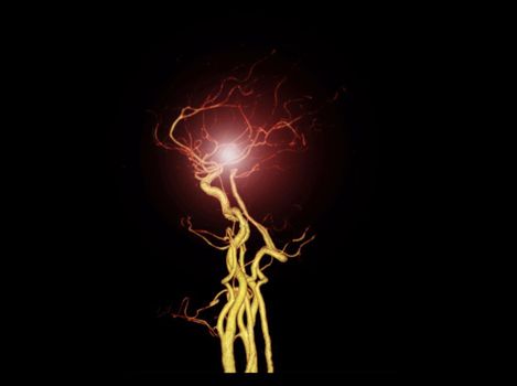 CTA BRAIN or CT angiography of the brain 3D Rendering image showing cerebral artery.