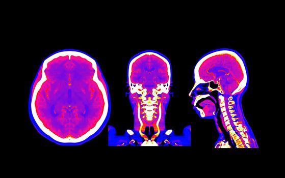 Collection colorful of CT angiography of the brain or CTA brain comparison Axial , Coronal and Sagittal view . Clipping path.