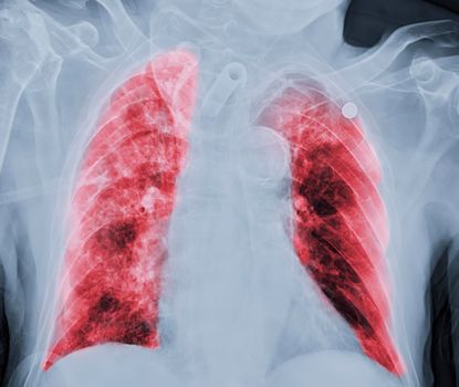 Chest X-ray or X-Ray Image Of Human Chest or Lung ( red zone ) showing tuberculosis
Tuberculosis (TB) and corona virus 2019.