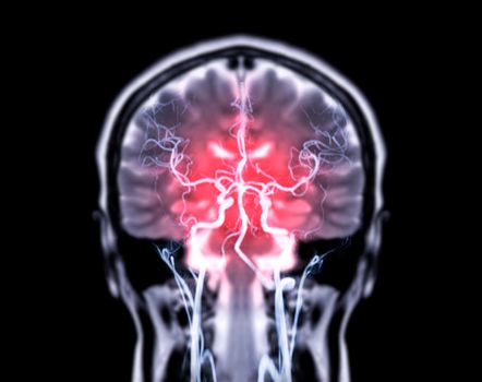 MRI brain Coronal T2W and MRA Brain fusion in Coronal view.