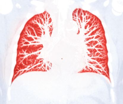 CT Chest Lung preset for detected tuberculosis
Tuberculosis (TB) and coronavirus 2019.