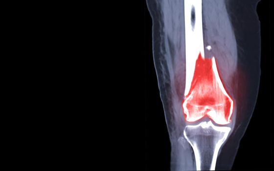 CT knee joint Coronal view isolated on black background showing fracture Femur bone.