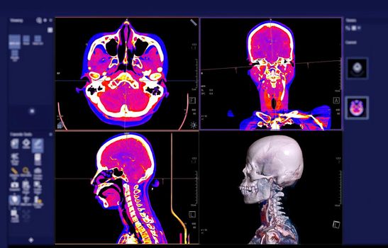 Colorful of CT angiography of the brain or CTA brain comparison Axial , Coronal and Sagittal view and 3D rendering on the screen.
