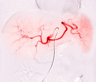 X-ray image of TOCE or Chemoembolization is a procedure that allows a dose of chemotherapy drugs to be administered directly to Liver tumor or HCC.