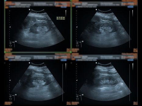 Ultrasound upper abdomen showing Liver, gall bladder and kidney for screening abdominal disease.