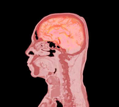 colorful of CT angiography of the brain or CTA brain Sagittal view . Clipping path.