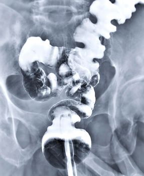 barium enema demonstrated l rectum and colon for diagnosis Colorectal cancer or colon cancer.