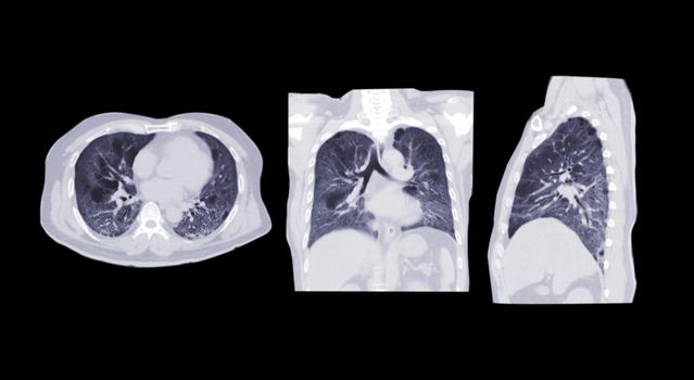 Collection of CT scan of Chest or lung axial, coronal and sagittal view of lung infection covid-19 with ground glass opacity isolated on black background. cliping path.
